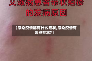 【感染疫情都有什么症状,感染疫情有哪些症状?】